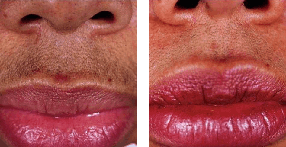 Laser hair removal lips before after