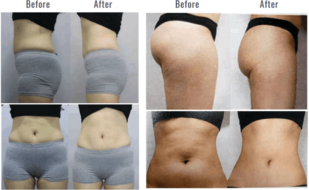 Laser hair removal lips before after